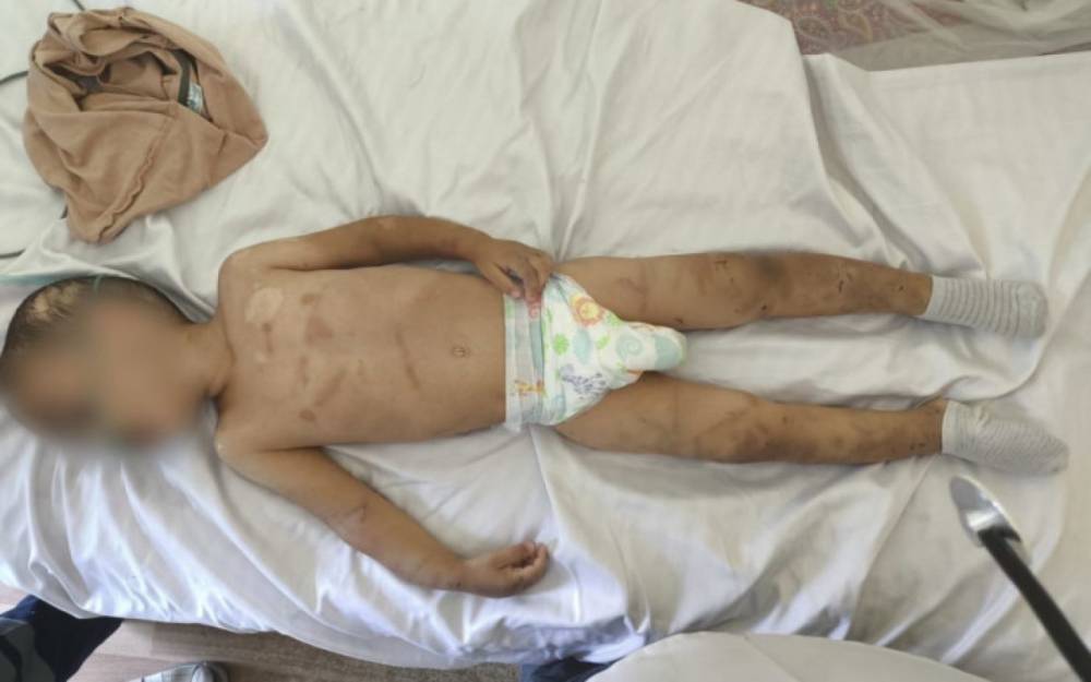 Valideynləri tərəfindən döyülən körpə süni nəfəs aparatına qoşuldu